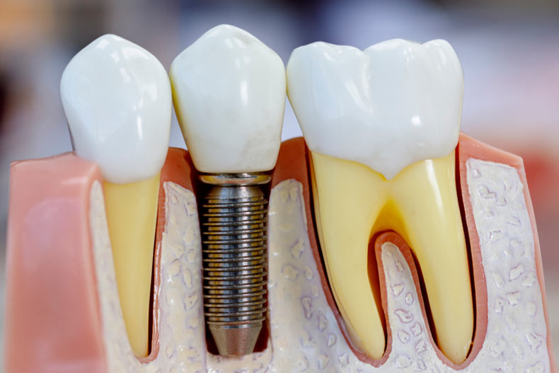 Dental Implants Louisville, Sheperdsville, and Jeffersonville IN